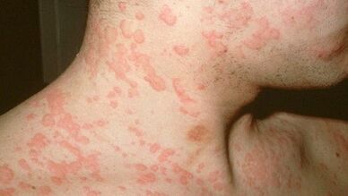 Quels parasites dans le corps peuvent provoquer des allergies